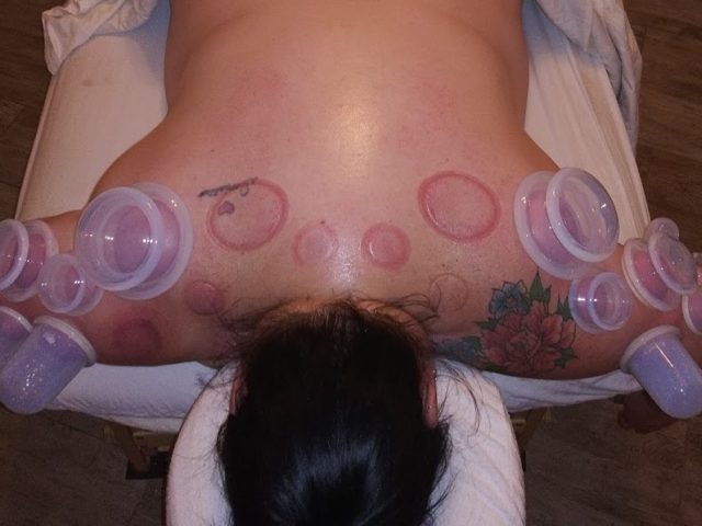 Picture of cupping during a massage